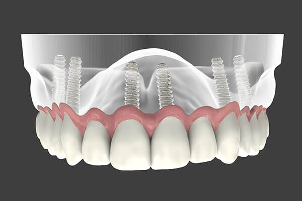 Implant Supported Dentures illustration