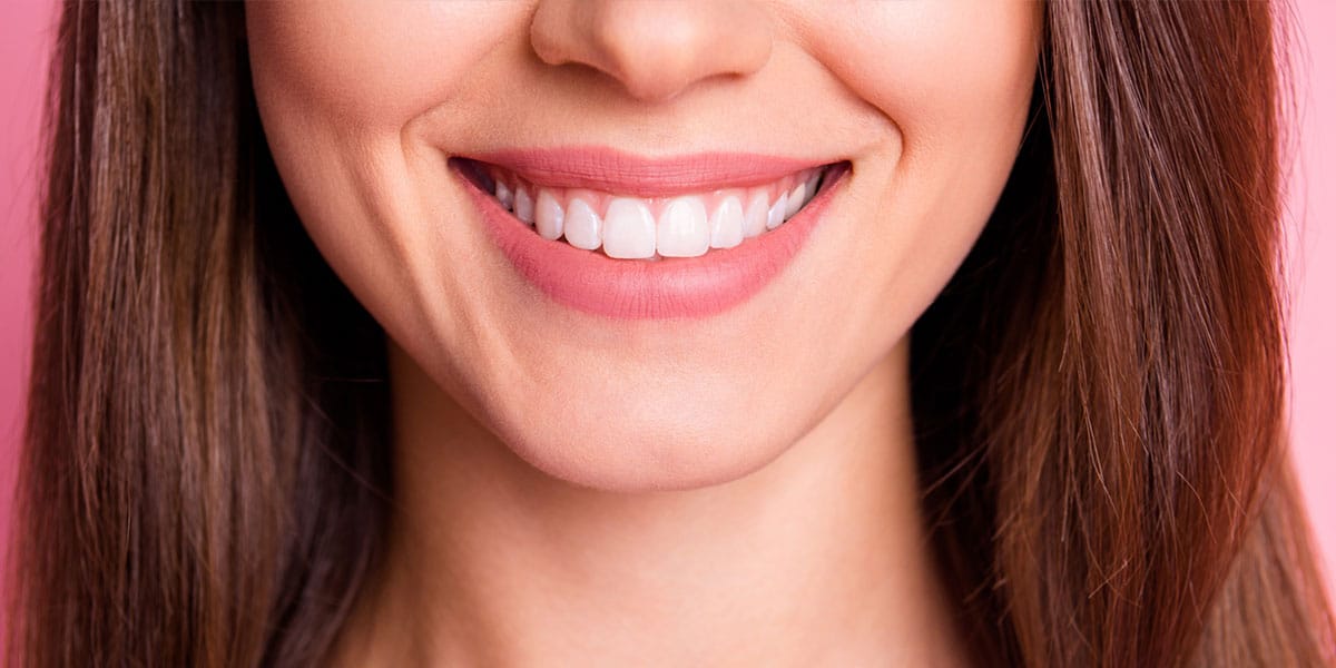 Closeup of Porcelain Veneers